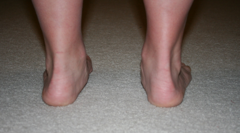 Correcting Overpronation